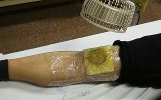 被黃胡蜂蟄了怎么辦，遠(yuǎn)離蜂巢后再用弱酸性溶液清洗傷處